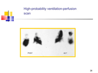 High-probability ventilation-perfusion scan   