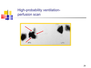High-probability ventilation-perfusion scan   