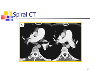Spiral CT 