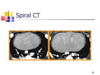 Spiral CT 