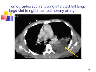 Tomographic scan showing infarcted left lung,  large clot in right main pulmonary artery 