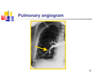 Pulmonary angiogram 