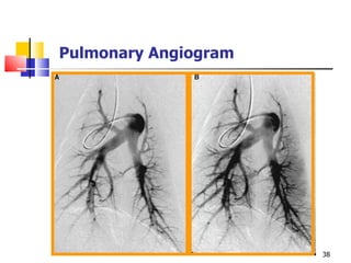 Pulmonary Angiogram 