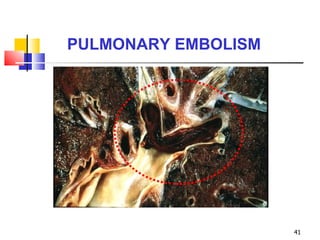 PULMONARY EMBOLISM 