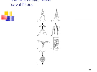 Various inferior vena caval filters 