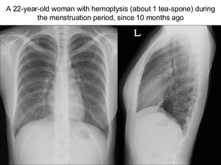 A 22-year-old woman with hemoptysis (about 1 tea-spone) during the menstruation period, since 10 months ago 