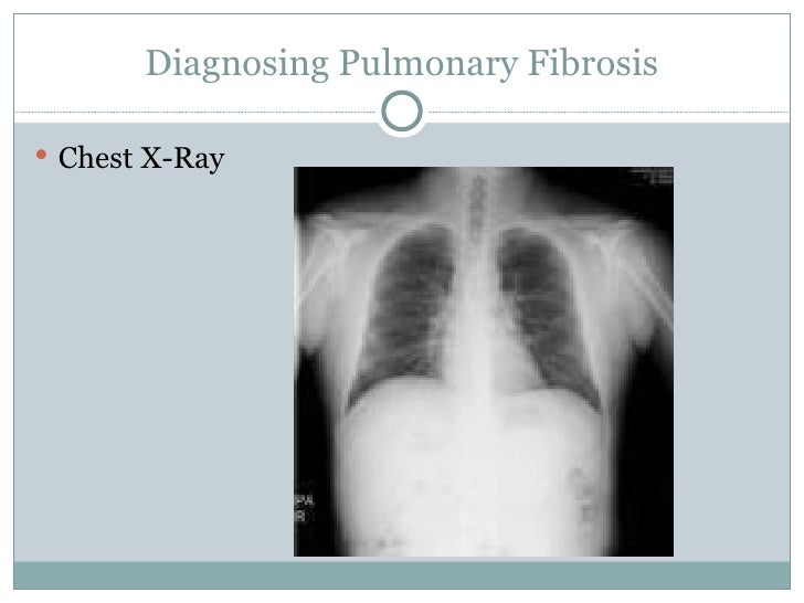 pulmonary fibrosis presentation pulmonary fibrosis presentation, Presentation templates