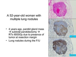 A 52-year-old woman with multiple lung nodules ,[object Object],[object Object],SMA AE1/AE3 