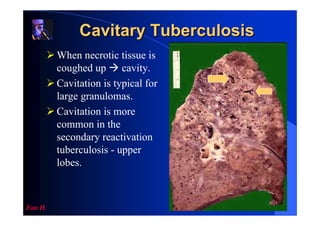Cavitary Tuberculosis
         When necrotic tissue is
         coughed up cavity.
         Cavitation is typical for
         large granulomas.
         Cavitation is more
         common in the
         secondary reactivation
         tuberculosis - upper
         lobes.



Fan H.
 