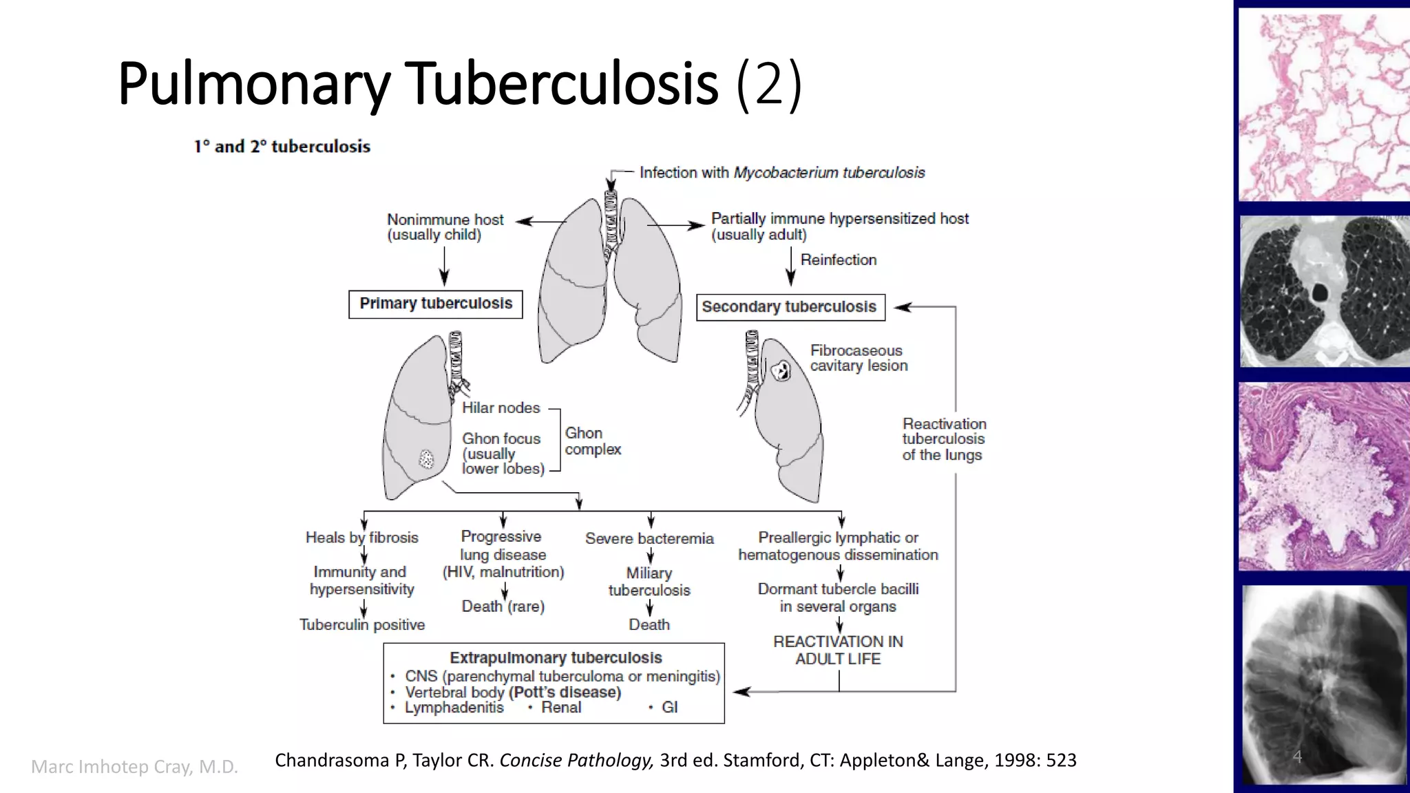 Pulmonary tuberculosis pharmacology | PDF