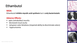 Marc Imhotep Cray, M.D.
Ethambutol
23
MOA:
Ethambutol inhibits mycolic acid synthesis but is only bacteriostatic
Adverse Effects:
 optic (retrobulbar) neuritis
 decreased visual acuity
 red-green color blindness (impaired ability to discriminate colors)
 hyperuricemia
 