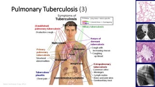 Marc Imhotep Cray, M.D.
Pulmonary Tuberculosis (3)
5
 
