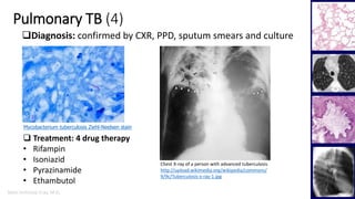 Marc Imhotep Cray, M.D.
Pulmonary TB (4)
6
Diagnosis: confirmed by CXR, PPD, sputum smears and culture
Chest X-ray of a person with advanced tuberculosis
http://upload.wikimedia.org/wikipedia/commons/
9/9c/Tuberculosis-x-ray-1.jpg
Mycobacterium tuberculosis Ziehl-Neelsen stain
 Treatment: 4 drug therapy
• Rifampin
• Isoniazid
• Pyrazinamide
• Ethambutol
 