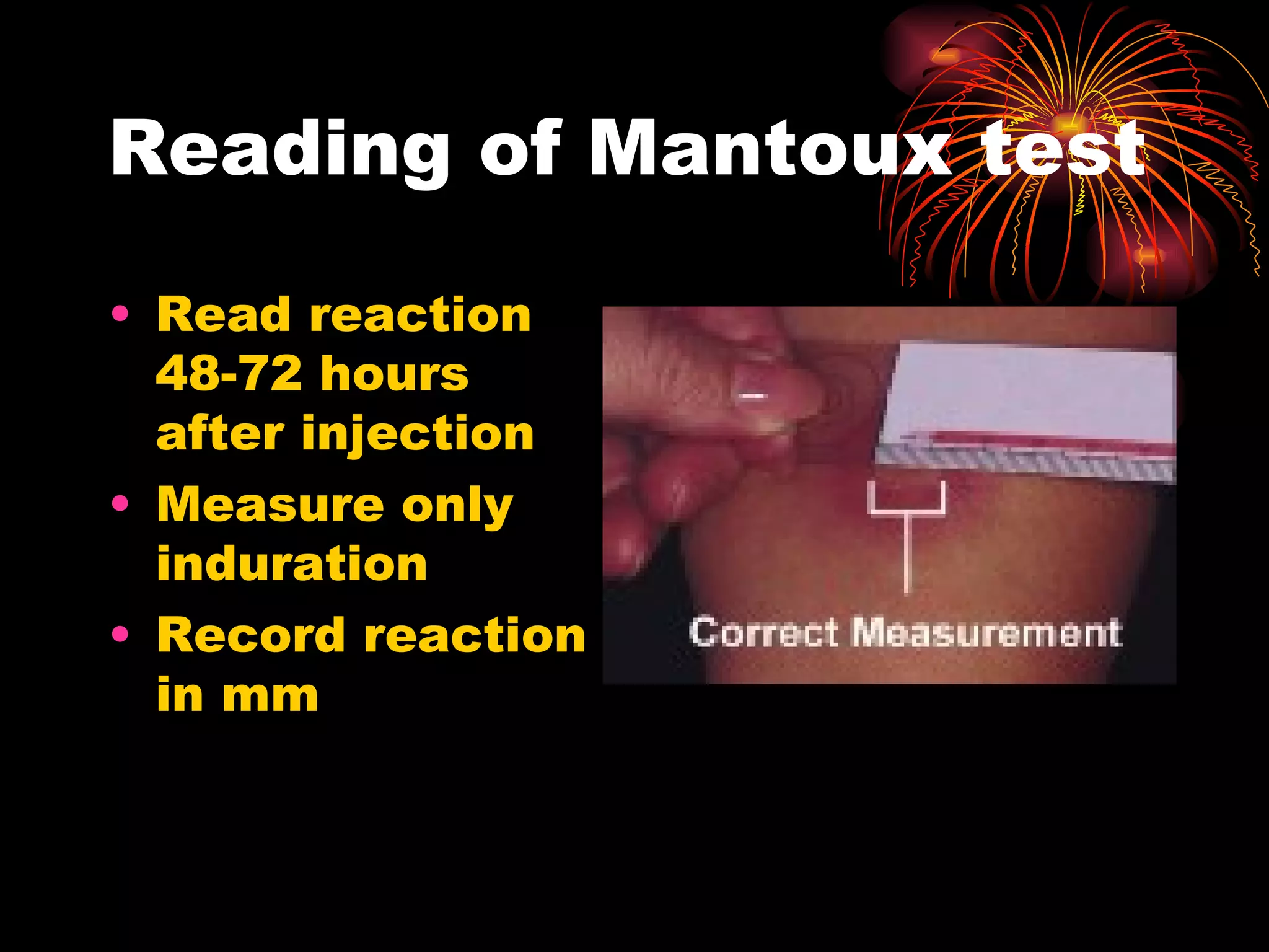 Reading of Mantoux test Read reaction 48-72 hours after injection Measure only induration Record reaction in mm 