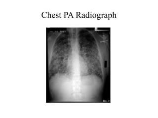 Chest PA Radiograph
 