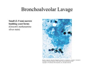 Bronchoalveolar Lavage
Small (2–5 nm) narrow
budding yeast forms
(Grocott's methenamine
silver stain)
 