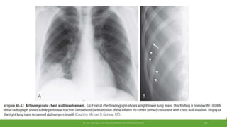DR. MD. SHAFIQUL ISLAM DEWAN, RESIDENT (PULMONOLOGY), DMCH 10
 