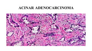 Histopathological subtypes and molecular alterations in pulmonary ...