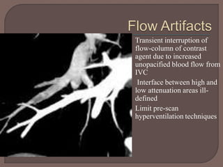 •
•
•
Transient interruption of
flow-column of contrast
agent due to increased
unopacified blood flow from
IVC
Interface between high and
low attenuation areas ill-
defined
Limit pre-scan
hyperventilation techniques
 
