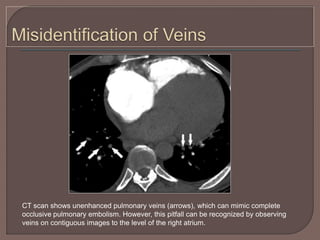 CT scan shows unenhanced pulmonary veins (arrows), which can mimic complete
occlusive pulmonary embolism. However, this pitfall can be recognized by observing
veins on contiguous images to the level of the right atrium.
 