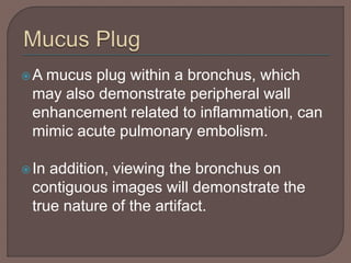 A mucus plug within a bronchus, which
may also demonstrate peripheral wall
enhancement related to inflammation, can
mimic acute pulmonary embolism.
In addition, viewing the bronchus on
contiguous images will demonstrate the
true nature of the artifact.
 