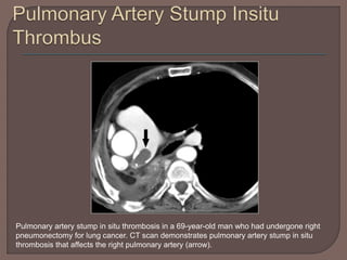 Pulmonary artery stump in situ thrombosis in a 69-year-old man who had undergone right
pneumonectomy for lung cancer. CT scan demonstrates pulmonary artery stump in situ
thrombosis that affects the right pulmonary artery (arrow).
 