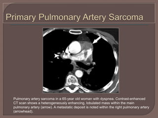 Pulmonary artery sarcoma in a 65-year old woman with dyspnea. Contrast-enhanced
CT scan shows a heterogeneously enhancing, lobulated mass within the main
pulmonary artery (arrow). A metastatic deposit is noted within the right pulmonary artery
(arrowhead).
 