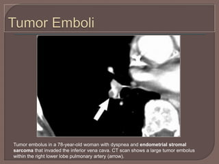 Tumor embolus in a 78-year-old woman with dyspnea and endometrial stromal
sarcoma that invaded the inferior vena cava. CT scan shows a large tumor embolus
within the right lower lobe pulmonary artery (arrow).
 