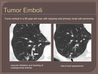 Tumor emboli in a 60-year-old man with dyspnea and primary renal cell carcinoma.
vascular dilatation and beading of
subsegmental arteries
tree-in-bud appearance
 