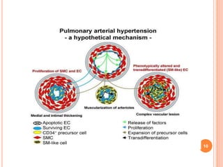 Pulmonary arterial hypertension | PPTX