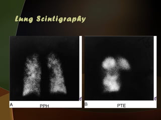 Pps Radiopaedia Pulmonary arterial hypertension | PPS