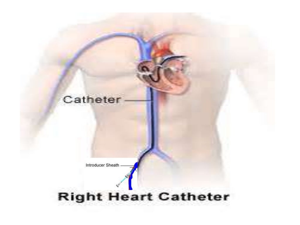 Pulmonary artery catheterization