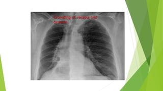 Crowding of vessels and
bronchi.
 