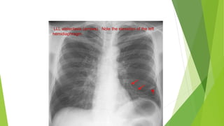 LLL atelectasis (arrows). Note the elevation of the left
hemidiaphragm.
 