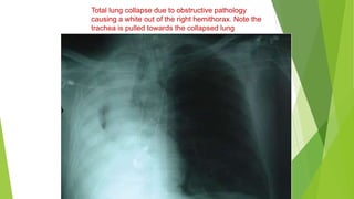 Total lung collapse due to obstructive pathology
causing a white out of the right hemithorax. Note the
trachea is pulled towards the collapsed lung
 