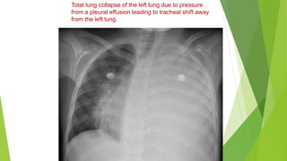 Total lung collapse of the left lung due to pressure
from a pleural effusion leading to tracheal shift away
from the left lung.
 