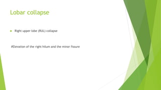 Lobar collapse
 Right upper lobe (RUL) collapse
#Elevation of the right hilum and the minor fissure
 