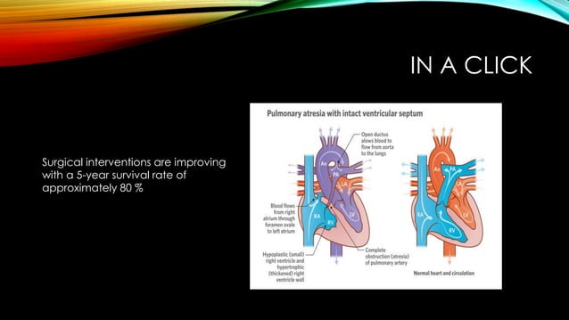 Pulmonary atresia with intact ventricular septum | PPTX | Heart and ...
