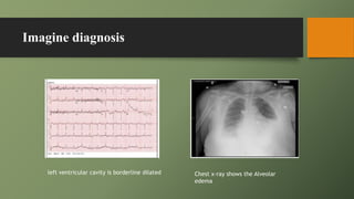 Imagine diagnosis
left ventricular cavity is borderline dilated Chest x-ray shows the Alveolar
edema
 