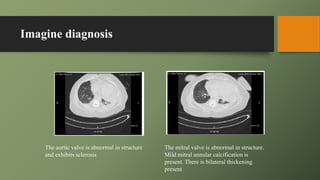 Imagine diagnosis
The aortic valve is abnormal in structure
and exhibits sclerosis
The mitral valve is abnormal in structure.
Mild mitral annular calcification is
present. There is bilateral thickening
present
 