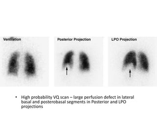 Imaging in pulmonary circulation disease | PPTX