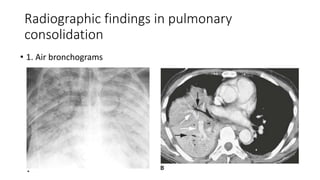 PULMONARY COLLAPSE AND CONSOLIDATION.pptx