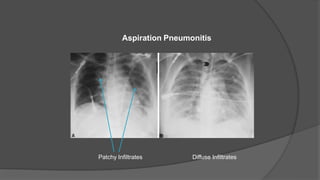 Patchy Infiltrates Diffuse Infiltrates
Aspiration Pneumonitis
 