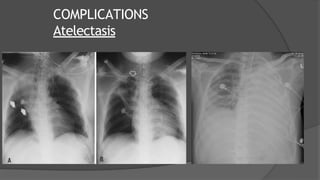 COMPLICATIONS
Atelectasis
 