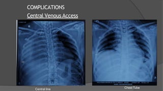 COMPLICATIONS
Central Venous Access
Central line Chest Tube
 