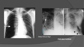 PNEUMOTHORAX
Deep Sulcus Sign
 
