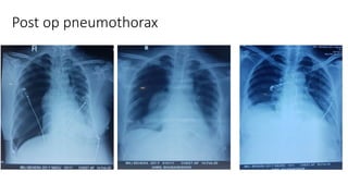 Post op pneumothorax
 