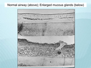 Normal airway (above); Enlarged mucous glands (below)
 