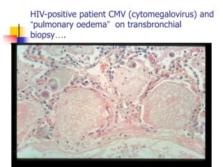 HIV-positive patient CMV (cytomegalovirus) and
“pulmonary oedema” on transbronchial
biopsy….
 