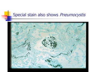 Special stain also shows Pneumocystis
 